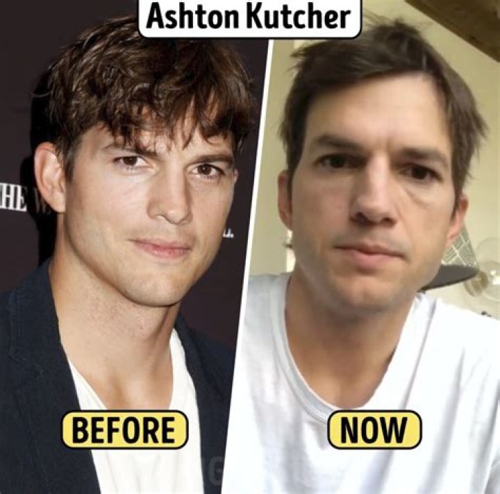 Ashton Kutcher Botox Then And Now- Did He Get A Nose Job?