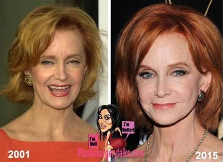 Before And After Pictures Of Actress Swoosie Kurtz’s Plastic Surgery Procedure