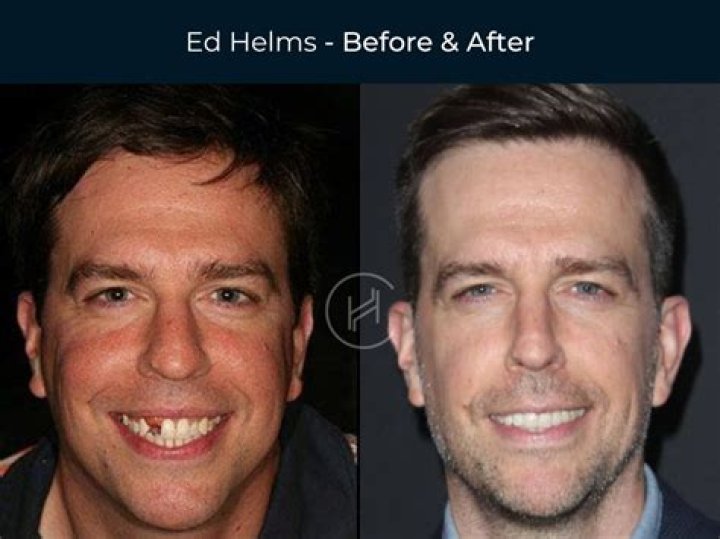 Does Freddie Freeman Have Fake Teeth or Veneers? Before and After Pictures